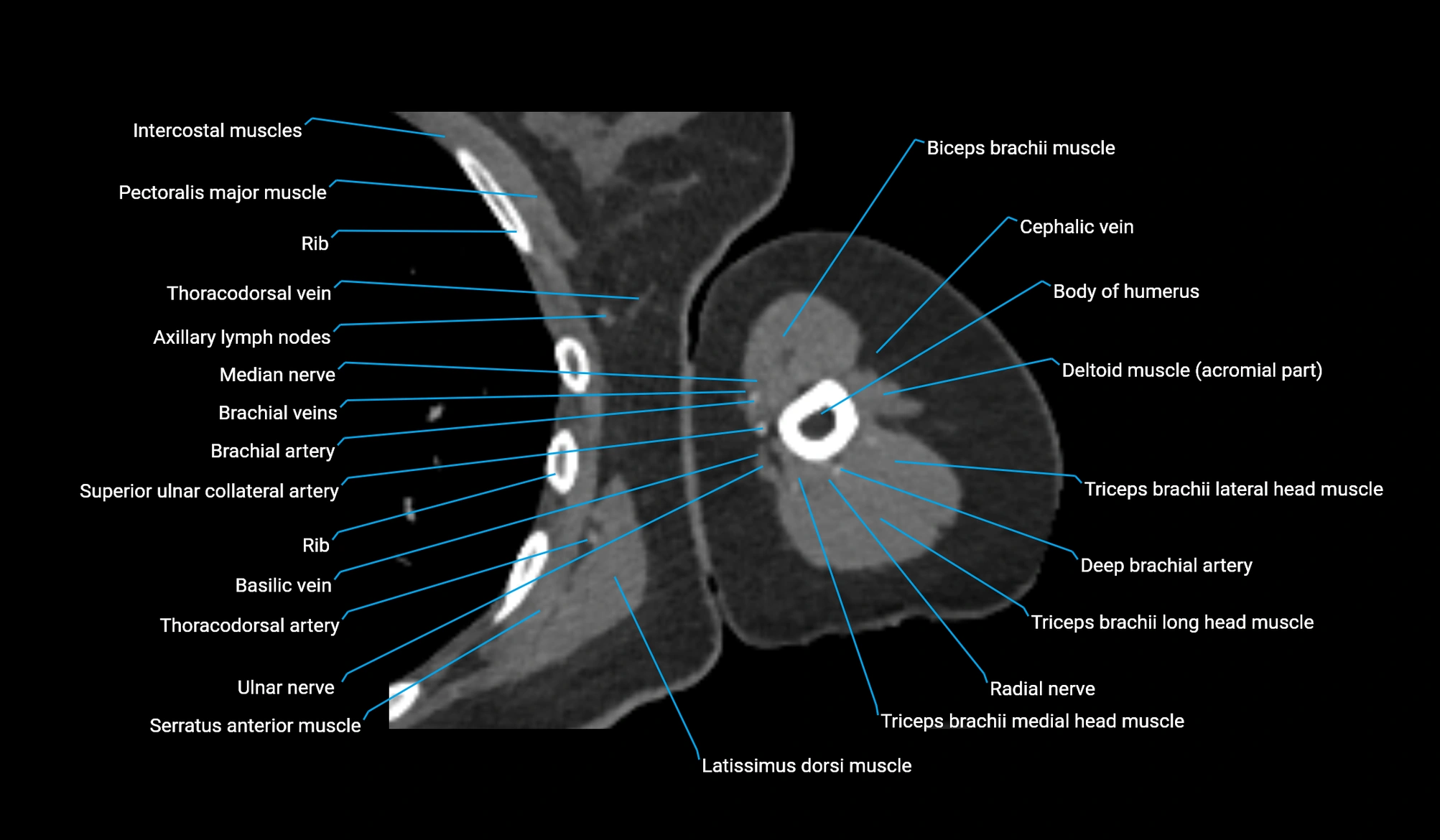 CT upper arm axial  cross sectional anatomy labelled radiology image -00214.webp